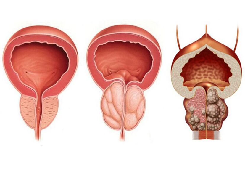 Stades de la prostatite et nécessité d'un traitement par Prostavit